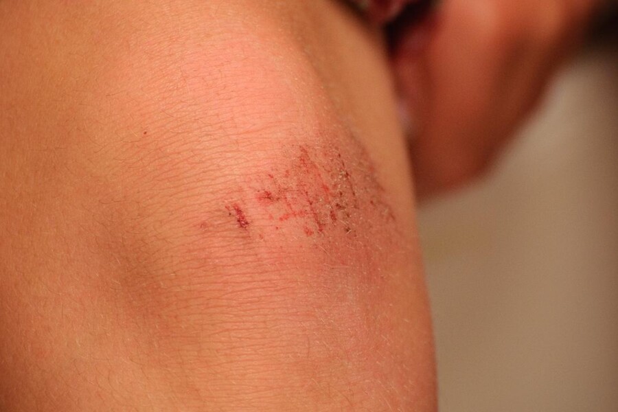 Zranění kolena u dětí