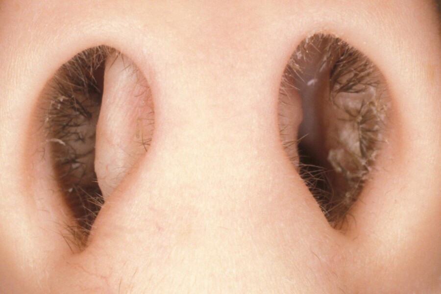 Vybočená nosní přepážka u dětí