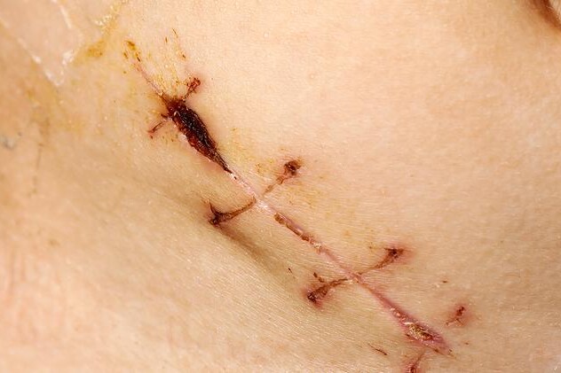 Zánět slepého střeva