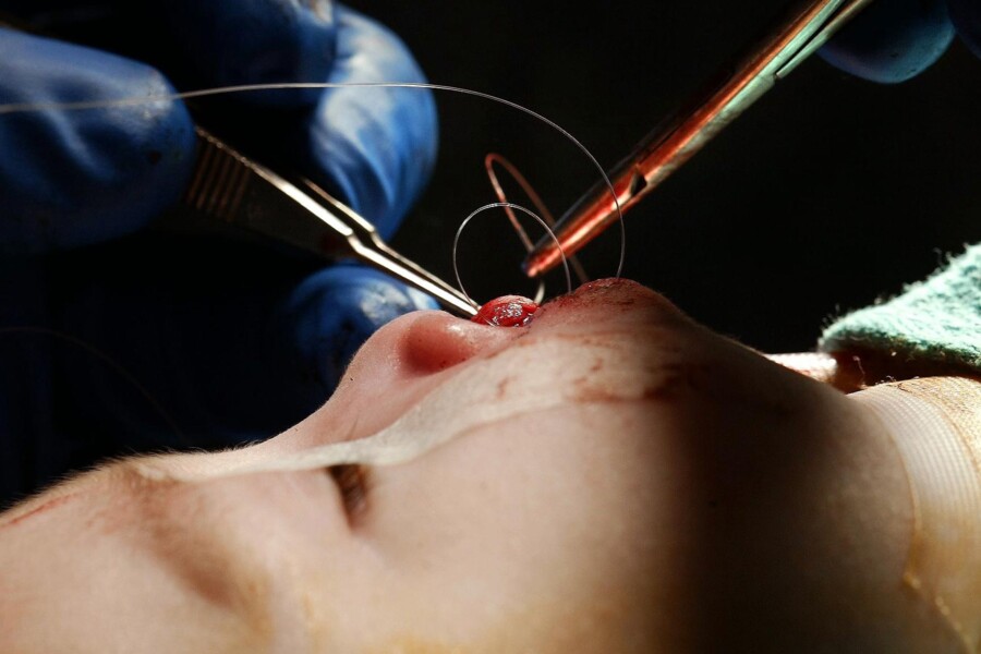 Rozštěp rtu a rozštěp patra