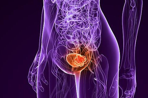 Nádor močového mechýře