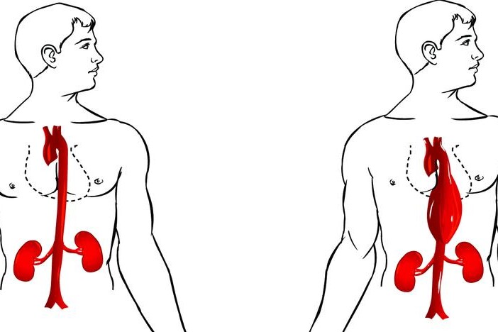Aneurysma a disekce aorty