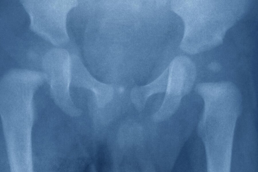 Kostální chondritida