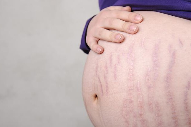 Strie a těhotenství
