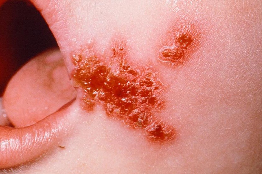 Impetigo