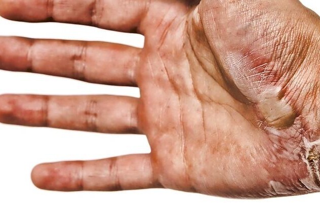 Jízvy po popáleninách