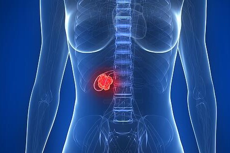 Rakovina žlučníku