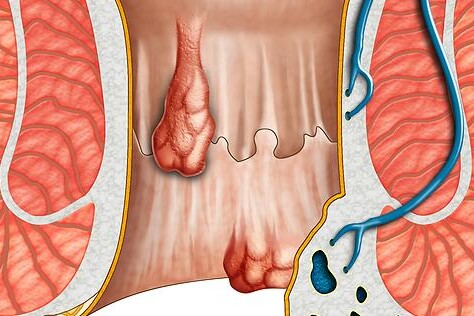 Hemoroidy