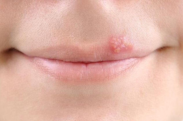 Herpes simplex
