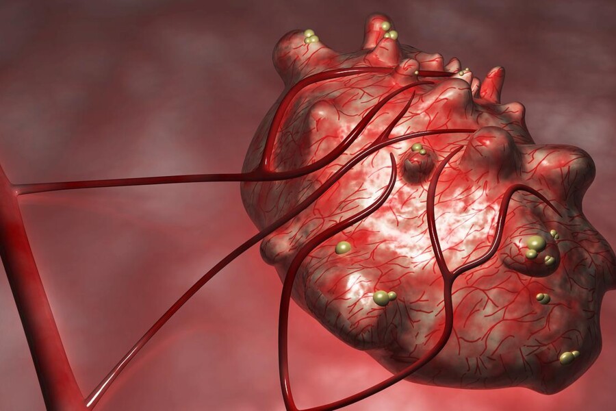 Ovariální nádory a cysty