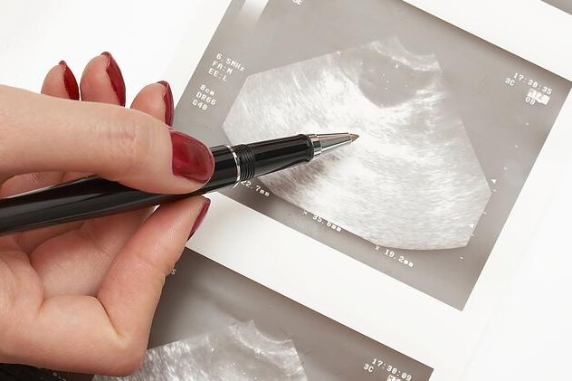 Cysta na vaječníku