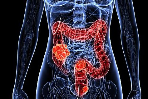 Nádor tlustého střeva