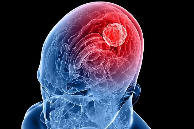 Nádory mozku