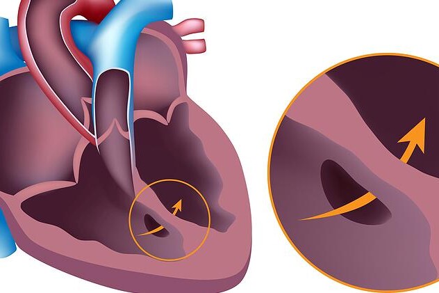 Vrozené srdeční vady
