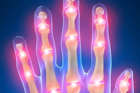 Revmatická artritida