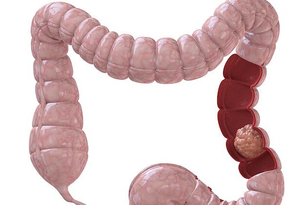 Operace tlustého střeva