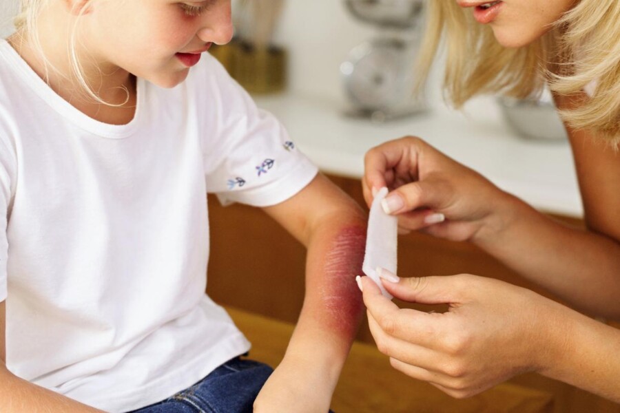 První pomoc při popáleninách u dětí