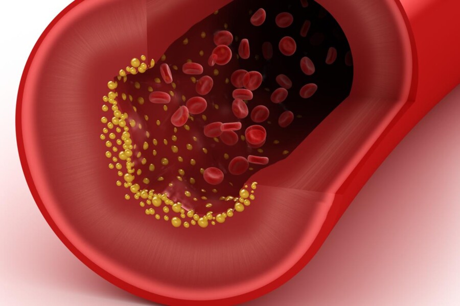 Vysoká hladina cholesterolu u dětí