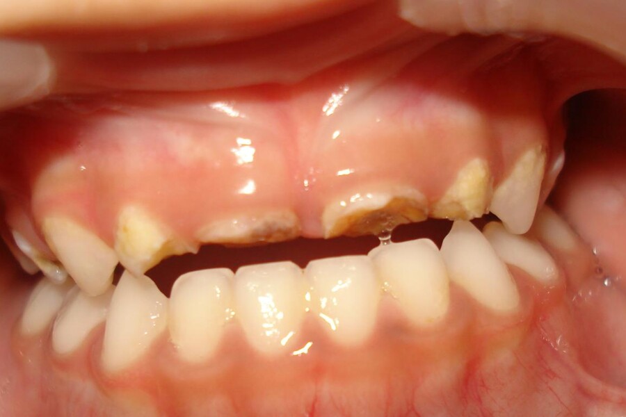 Stav chrupu dětí je alarmující