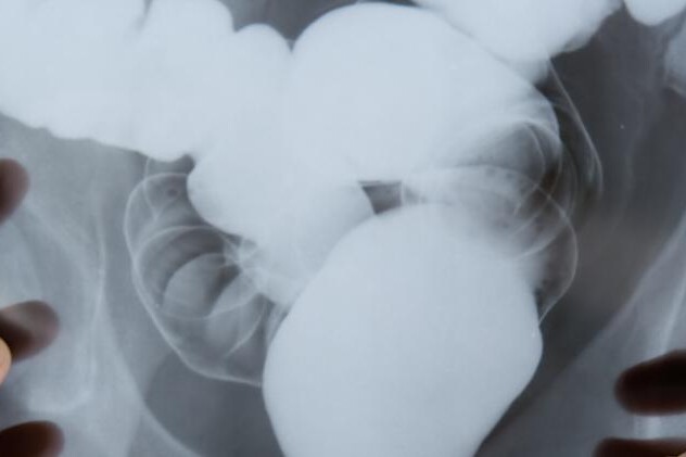 Ulcerózní kolitida