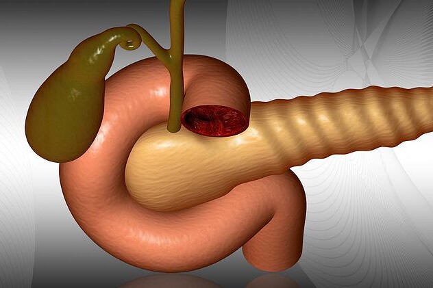 Akutní zánět slinivky