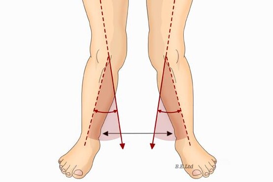 Vbočená kolena u dětí