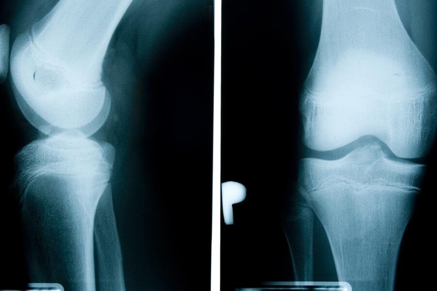 Osgoodova-Schlatterova nemoc