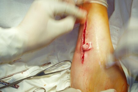 Osteomyelitida u dětí