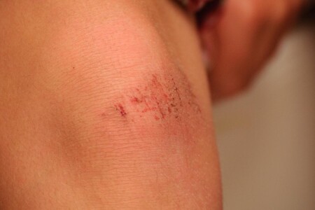 Zranění kolena u dětí