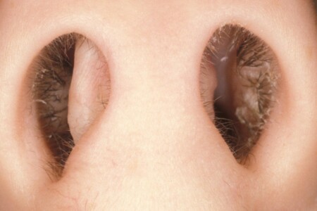 Vybočená nosní přepážka u dětí