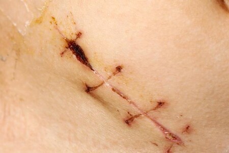 Zánět slepého střeva