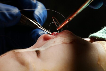 Rozštěp rtu a rozštěp patra