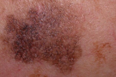 Lentigo