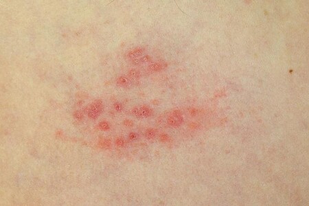 Pásový opar - herpes zoster