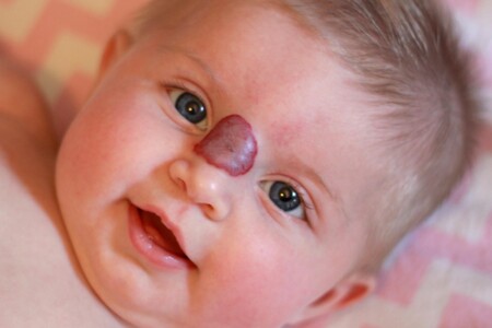 Mateřská znaménka u dětí