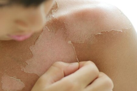 Popáleniny u dětí