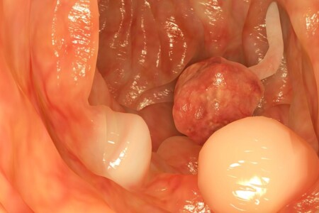 Střevní polypy u dětí