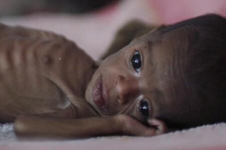 Podvýživa u dětí