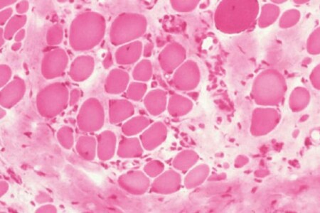 Svalová dystrofie u dětí