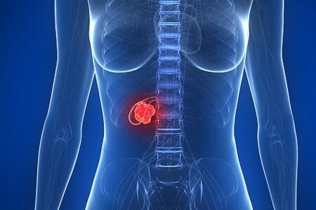 Rakovina žlučníku