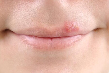 Herpes simplex