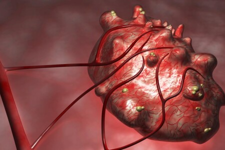 Ovariální nádory a cysty