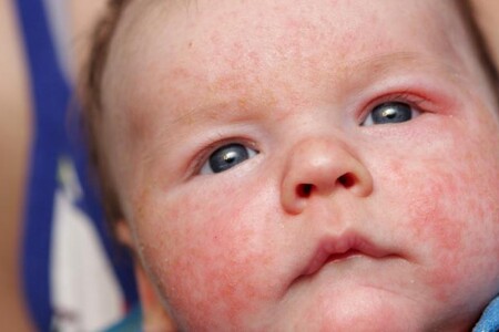 Atopický ekzém u kojenců