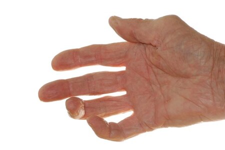 Revmatoidní artritida