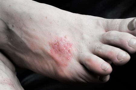 Lupénka a její příznaky