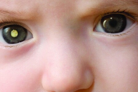 Retinoblastom u dětí