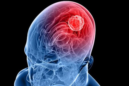 Nádory mozku