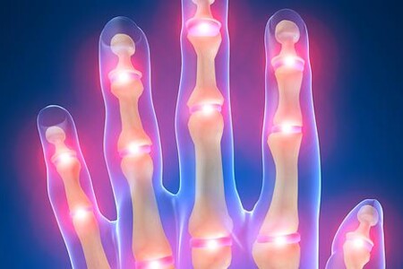 Revmatická artritida