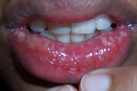 Herpetická gingivostomatitida