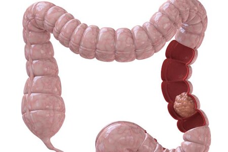 Operace tlustého střeva